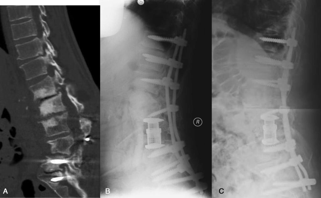 Figure 4. A patient without proximal complications. (A) Preoperative sagittal computed tomographic scan demonstrating lumbar kyphotic deformity following anterior and posterior fusions.
