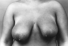 A B nipple-areola complex; (4) severe ptosis with nipple-areola complex positioned below the inframammary line, more severe on the right side; (5) breast contour poorly defined, with excess breast