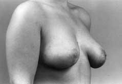 This diagnosis involves the following parameters: (1) breast-body relationship; (2) symmetry; (3) shape and location of the nipple-areola complex; (4) relationship between the inframammary sulcus and