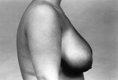 In this patient, the findings were as follows: (1) breast hypertrophy; (2) right breast larger than the left breast, with wide bilateral bases; (3) left nipple-areola complex deviated medially and