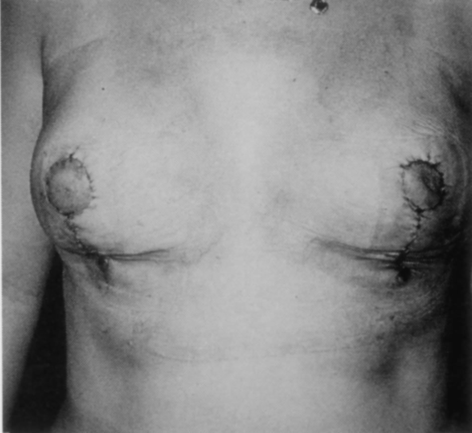 Vol. 112, No. 3 / VERTICAL REDUCTION MAMMAPLASTY 859 FIG. 5. Immediate postoperative result of the Lejour technique.