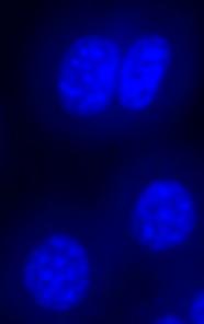 NFKBIA Sensitizes Glioblastoma Cells to Temozolomide.