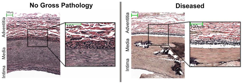 Kamenskiy et al. Page 26 Figure 6. Representative histology of SFA cross-sections with no gross pathology (left) and with severe atherosclerotic disease (right) both stained with Verhoeff-Van Gieson.