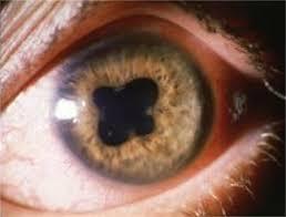 Ophthalmologic Disorders Antimuscarinic agents, administered topically as eye drops or ointment, produce mydriasis and cycloplegia are very helpful in doing a complete examination.
