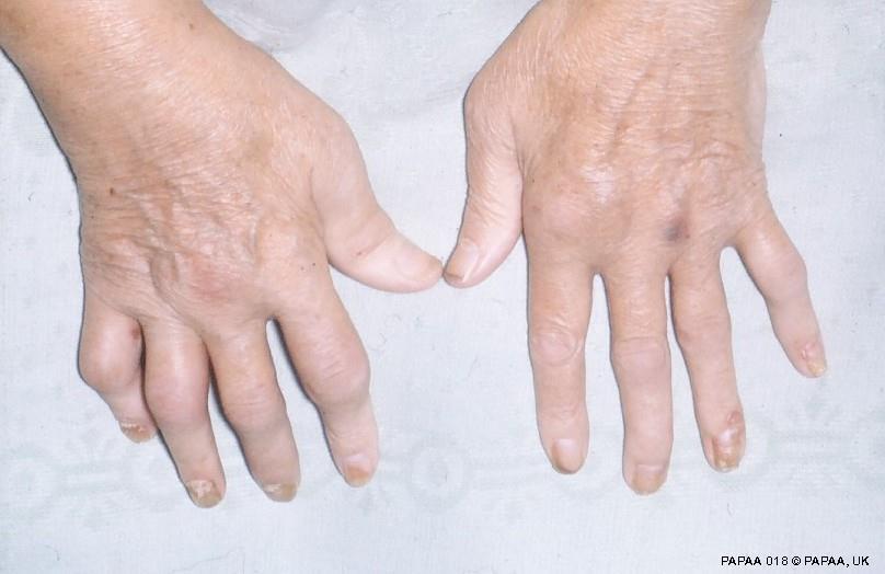 2 Information about Psoriatic Arthritis Psoriatic arthritis (PsA) is a form of arthritis affecting individuals with psoriasis. Joints become inflamed, which causes pain, swelling and stiffness.