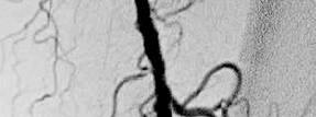 Long SFA Occlusions