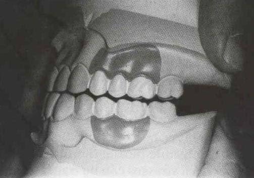 2. Tooth supported RPD Occlusion for