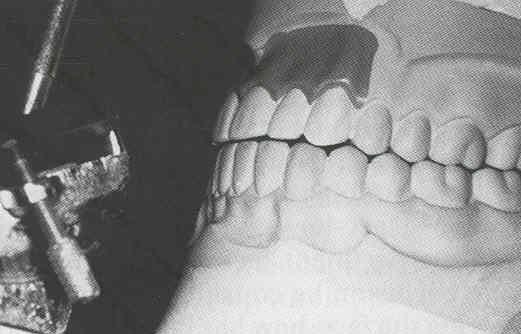 6. Kennedy Class IV Contact of opposing teeth