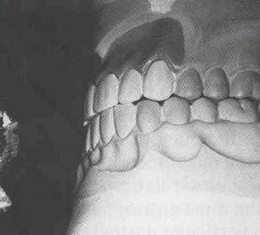 anterior teeth in eccentric movement is