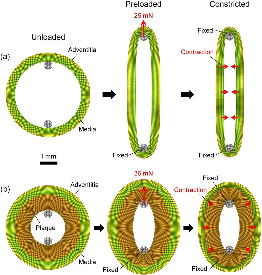 Figure 5.4 (a) Healthy and (b) atherosclerotic artery models for the modelling of the endothelin-1 response of arteries, showing the unloaded, pre-loaded, and constricted states of the arteries.