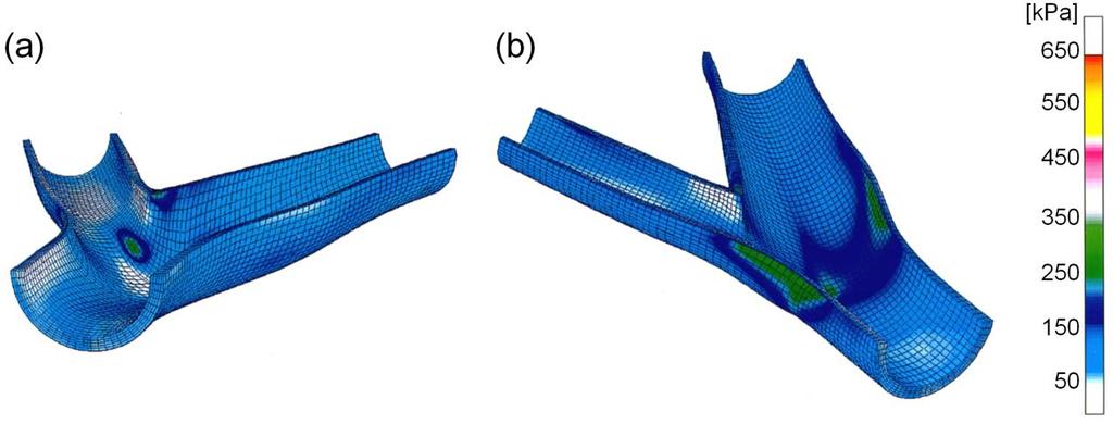 Figure 2.14 Three-dimensional finite element model of human carotid bifurcation in the study of Delfino et al. (1997), showing the stress distribution in the arterial wall. 2.5.