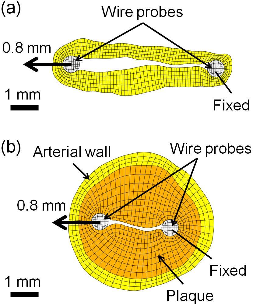 Figure 4.3 Finite element models of the (a) healthy and (b) atherosclerotic artery rings shown in Figure 4.2.