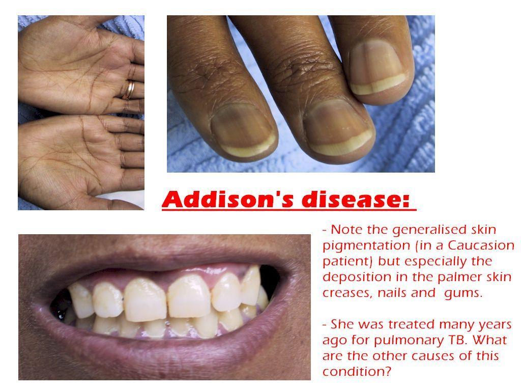 Addison s disease