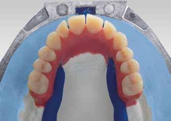 Finishing of the denture base The teeth reduced on the palatal and occlusal surface are