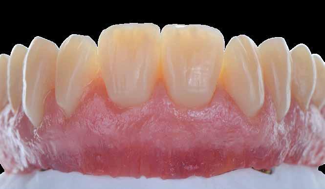 Gingival modification