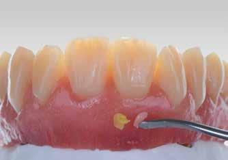5 6 7 5 Gingiva G1 6 Gingiva G4 7 Intensive Gingiva IG4 / Intensive Gingiva IG3 in a ratio of 1:5 + Immobile mucosa The alveolar parts of the immobile mucosa and the cervical structures can be