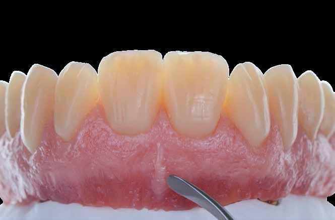 Gingival modification The