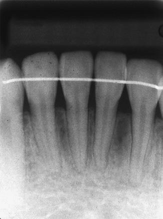 She was preparing for entrance examinations to college, and her oral esthetic problems seemed to be compounding the stress. Generally, plaque accumulation and gingival inflammation was minimal (Fig.