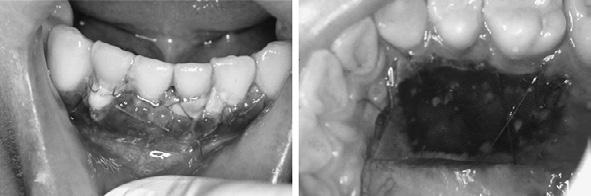 Connective Tissue Graft for Recession 159 Fig. 5 Oral view at 1 week postoperatively Fig. 6 Oral view at 2 weeks postoperatively Fig.