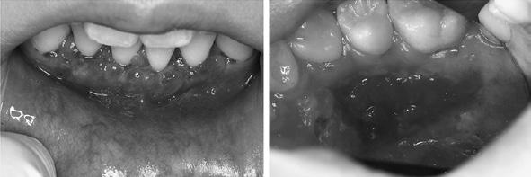 The sutures were removed after 2 weeks. Surface irregularity was observed at the site of the graft (Fig. 6).