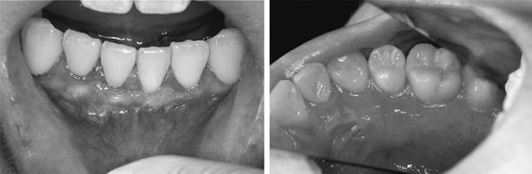 At 3 months postoperatively, the surface irregularity and bleeding at the gingival margin of the recipient site became less pronounced (Fig.