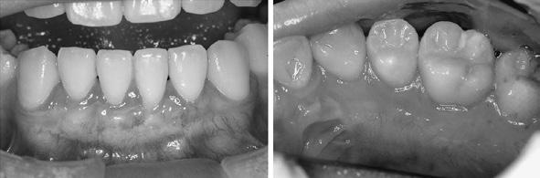 160 Egawa M et al. Fig. 8 Oral view at 6 months postoperatively Discussion In this case, an attempt was made to improve esthetics in the mandibular incisor area.
