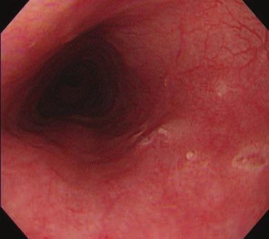 Endoscopic findings of UGI lesions