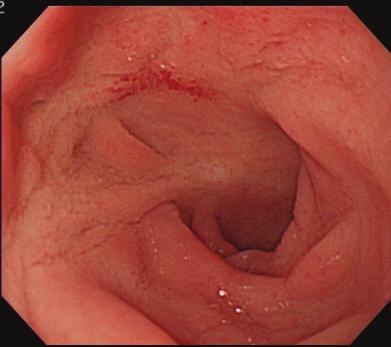 We assume that a similar pathogenic process as in the ileum and colon is taking place in the UGI lesions of CD patients.
