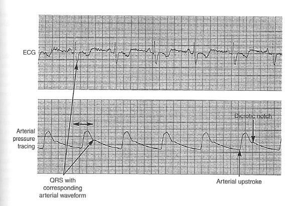 5. Arterial Monitoring The arterial pressure wave corresponds with the cardiac cycle. Arterial systole begins with opening of aortic valve and rapid ejection of blood into the aorta.