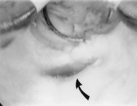 FIGURE 3 Posterior cervical canal during shaving of obstructing tissue. The perforation site (arrow) was subsequently cauterized closed.