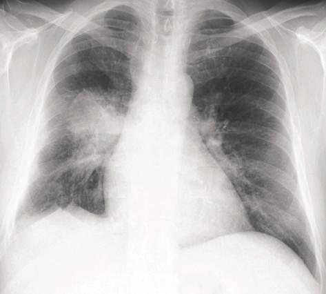 2 Case Reports in Medicine Figure 1: CXR showing right lower lobe mass lesion at the time of presentation.