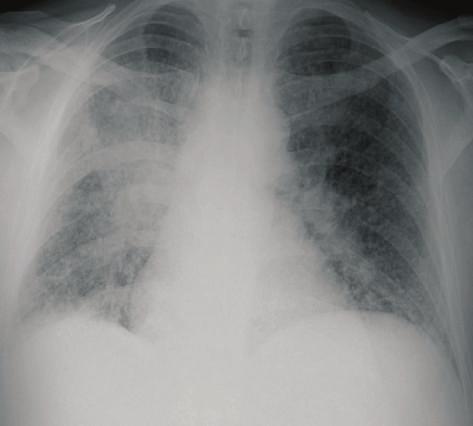CXR showed progression of the radiological changes, in the intervening two weeks from the initial imaging, with a new development of a miliary pattern (Figure 3).