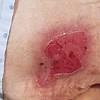 STAGE 2 PRESSURE ULCER If shallow or opened blister Transparent dressing, or hydrophilic wound