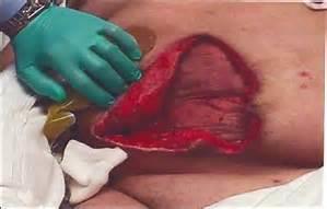 STAGE 4 PRESSURE ULCER In clean wounds, use wound vac In wounds with slough or necrotic tissue, use