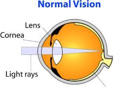 emmetropia g. strabismus b. myopia h. conjunctivitis c. hyperopia i. cataract d.