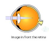 keratoconus m. amblyopia n. diabetic retinopathy o.