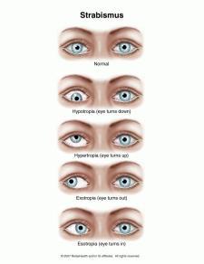 STRABISMUS VISUAL DISORDERS SARAH THORNBURG CROWN 85 VISUAL PERCEPTION What is it? When both eyes are not aligned and so look in different directions. What are the symptoms?