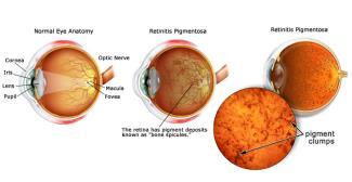 Lazy eye can be treated with eyeglasses, prisms, vision therapy, and eye patching. DIABETIC RETINOPATHY What is it?