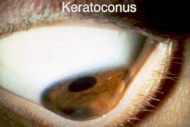 keratoconus conjunctivitis (conditions known as pink-eye ) http://www.