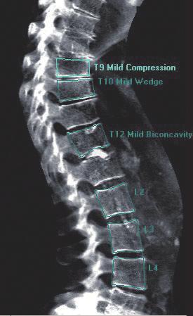 It s vertebral assessment is comparable to radiographs in identifying and classifying deformities concerning etiology, grade, and shape, 1 while using a lower dose of radiation.