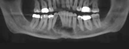 Fig. 1: Preop Panorex shows tumor of the anterior mandible.