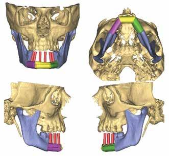 Implant positioning was included in the virtual plan to establish ideal position and angulation (Fig. 2).