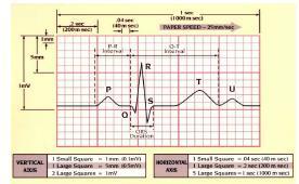 a) Bradycardia b) Tachycardia Bradycardia: - In bradycardia the heart rate is less than 60 beats/min.