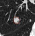 No evidence of metastases on FDG PET. IMAGING 5/1/2000 Prior 2 Small Cell Lung Cancer RECIST Lesion Lesion 1 6.8 cm 6.