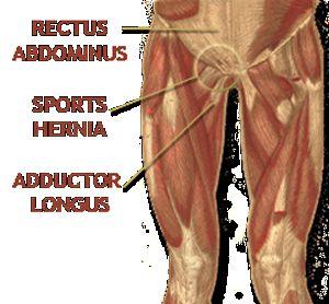 Core Muscle Injury AKA Sports Hernia Extreme hip