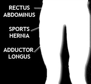 abdominal and/or adductor musculature from pubis