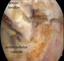 Intra-Articular Pathologies (5%) Isolated labral