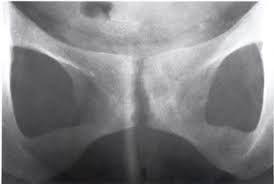 Osteitis Pubis Inflammation in the symphysis pubis Usually from repetitive overuse Treated