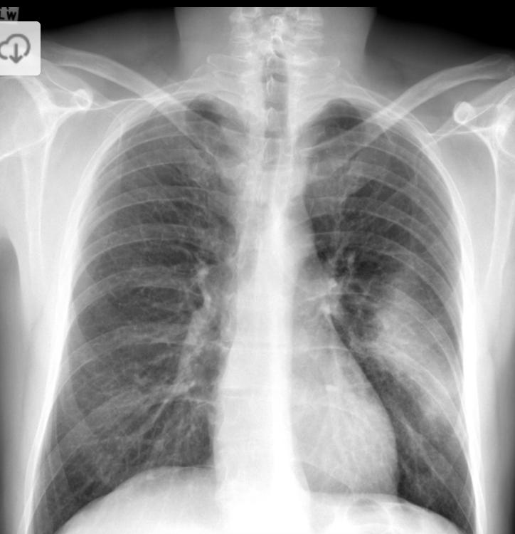 clinical ﬁndings suggest Staph aureus pneumonia