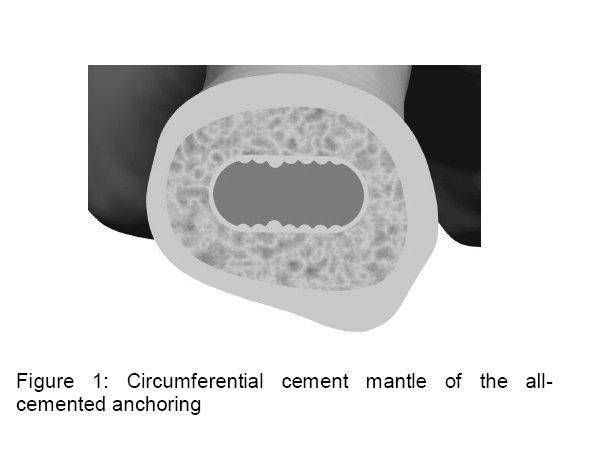 Introduction and product description For decades the Müller Straight Stem has been an established hip endoprosthesis for cemented fixation.